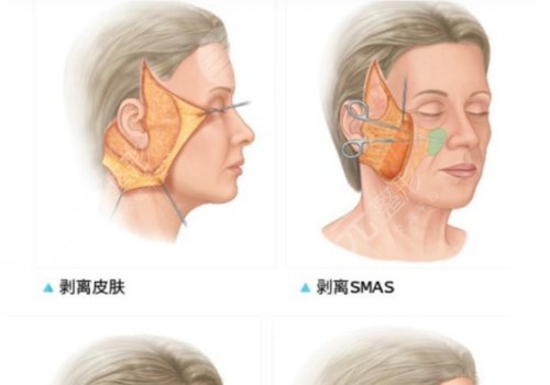 拉皮手術(shù)多大年齡做合適？