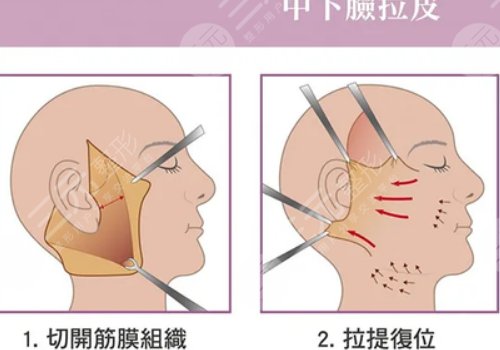 拉皮手術(shù)多大年齡做合適？