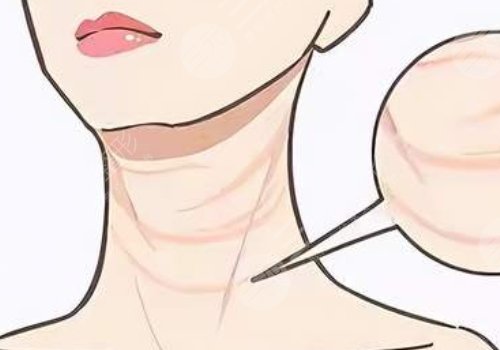 頸紋填充能維持多久呢？色素沉著能消退嗎？