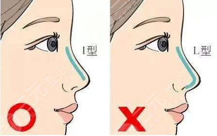 膨體隆鼻的缺點有哪些？多少錢|怎么護理？