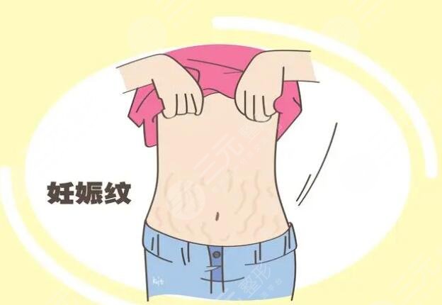 橄欖油去除妊娠紋需要配合使用身體乳嘛？使用方法