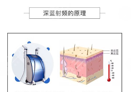深藍(lán)射頻間隔多久做一次？