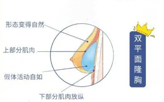 魔滴假體隆胸多少年更換?