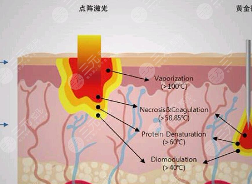 做完點(diǎn)陣激光需要注意哪些問題呢?