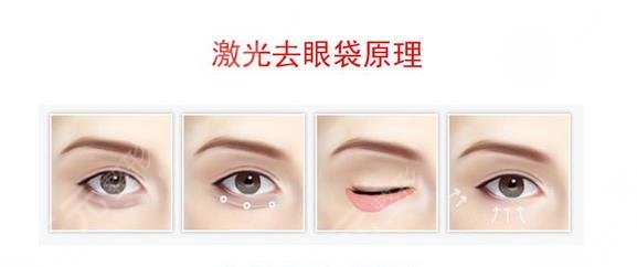 廣州健麗去眼袋案例