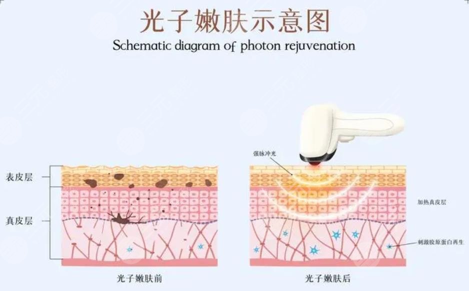 光子嫩膚