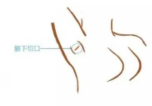 隆胸腋下切口的優(yōu)勢和缺點(diǎn)有哪些？