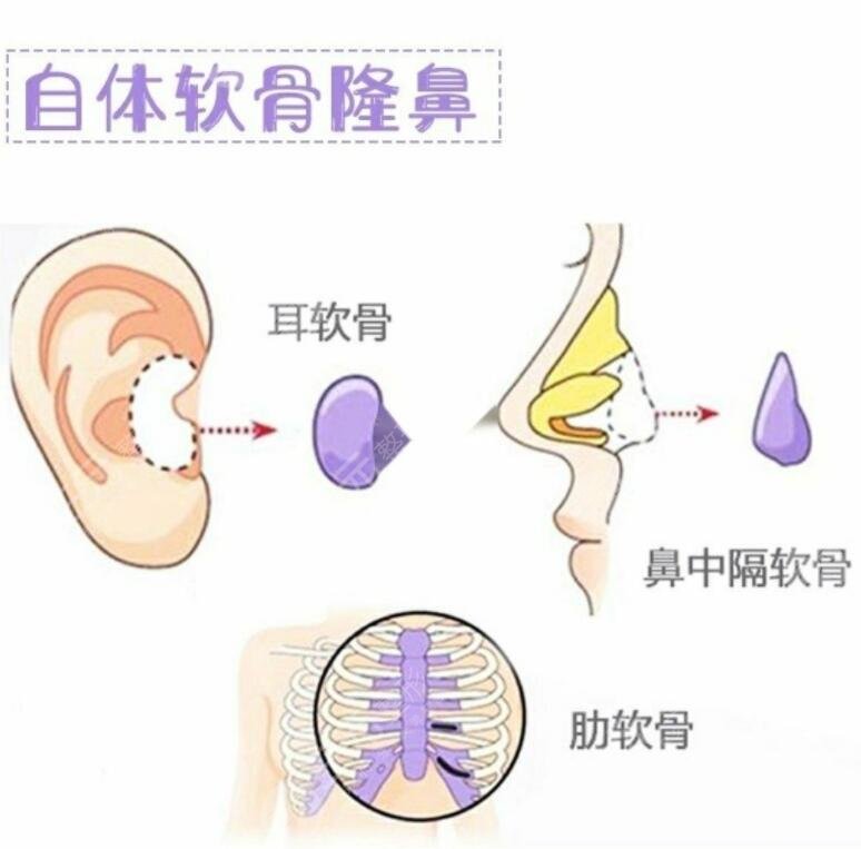 耳軟骨墊鼻尖能維持幾年？
