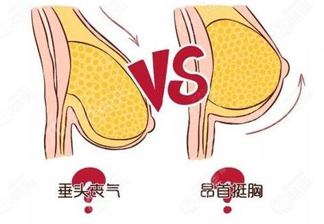 下垂胸怎么矯正有效果？手術(shù)與非手術(shù)方法都可選！產(chǎn)后媽媽的救星！