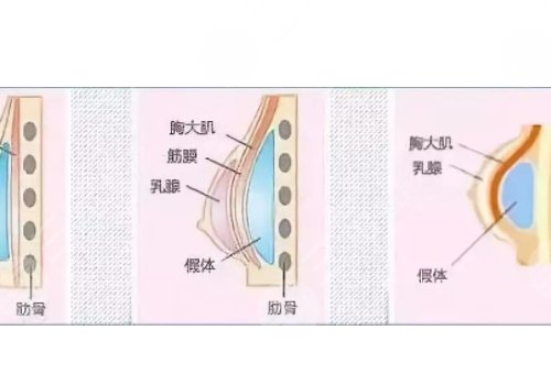 光面假體隆胸后需要怎么樣按摩？