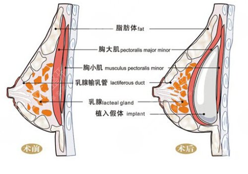 光面假體隆胸后需要怎么樣按摩？