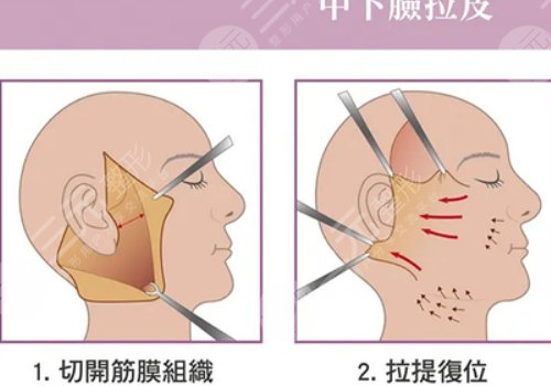 小拉皮和大拉皮的區(qū)別在哪里？