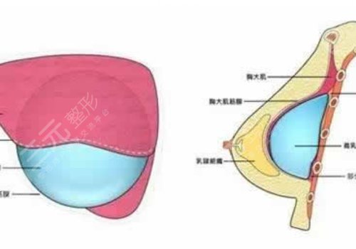 毛面假體和光面假體哪個(gè)好?