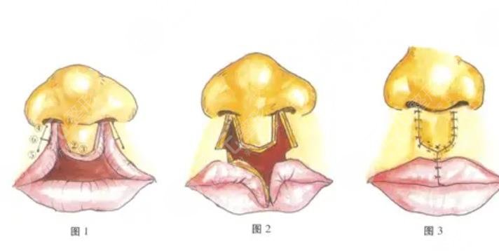 唇部修復(fù)