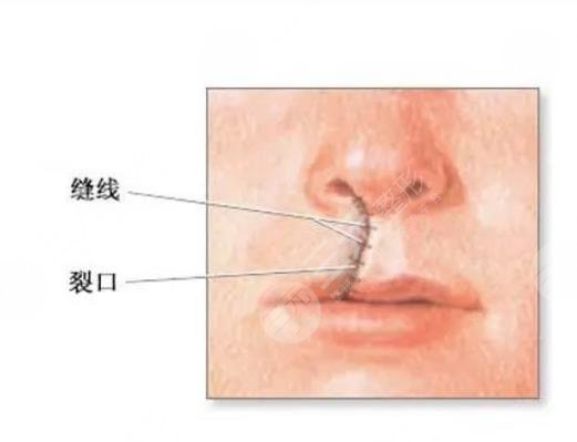 唇部修復(fù)