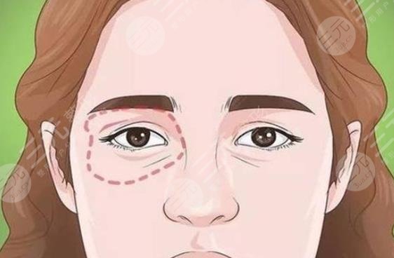 內切眼袋多久恢復正常