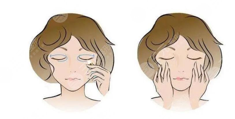 內切眼袋多久恢復正常
