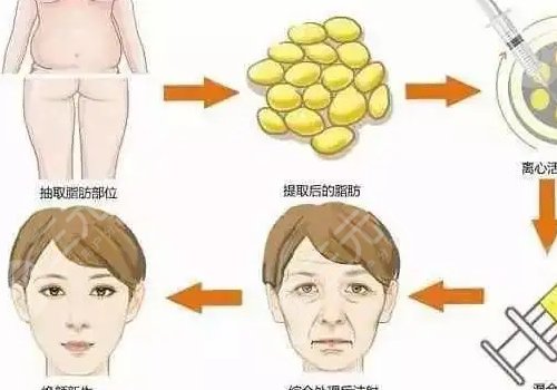 面部脂肪填充多久能恢復自然？