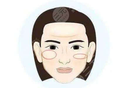 顴骨內(nèi)推