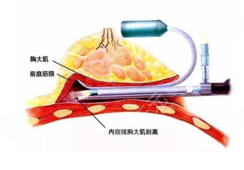 雙平面內(nèi)窺鏡隆胸幾天能不疼？