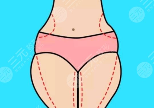 大腿吸脂