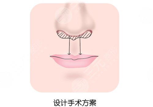縮短人中手術(shù)會(huì)留疤嗎？
