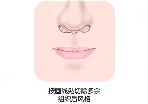 縮短人中手術(shù)會(huì)留疤嗎？