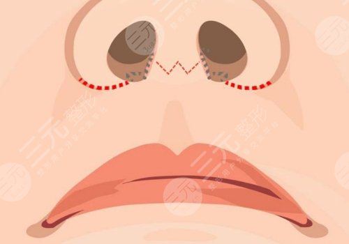 縮短人中手術(shù)會(huì)留疤嗎？