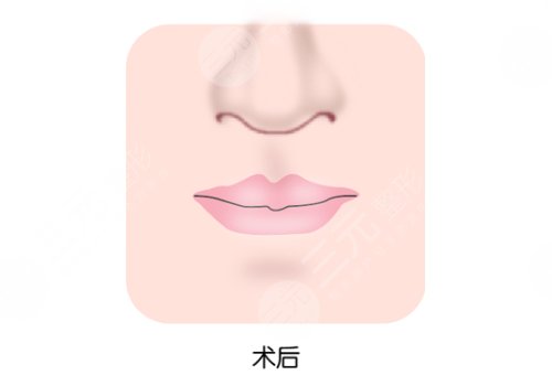 縮短人中手術(shù)會(huì)留疤嗎？