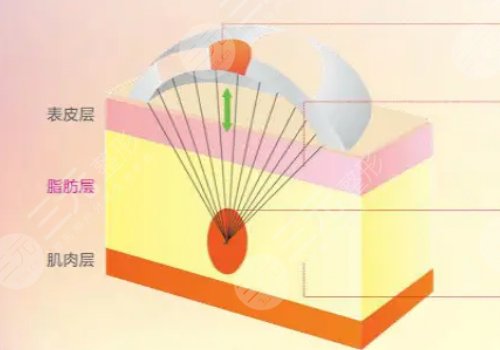 電波拉皮效果好嗎能維持多久？