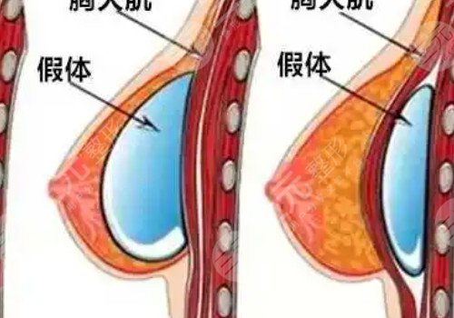 胸修復(fù)需要更換假體嗎？