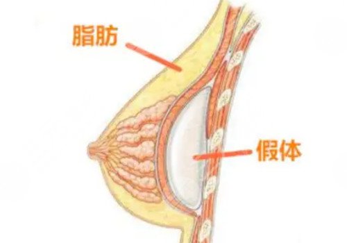 胸修復(fù)需要更換假體嗎？