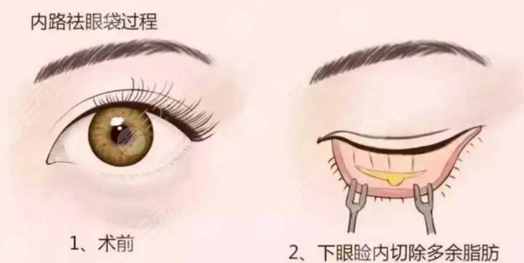 內(nèi)切眼袋加眶隔釋放恢復(fù)期