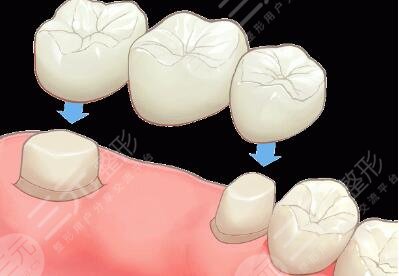烤瓷牙修復能美白牙齒嗎？多少錢？使用壽命是幾年？