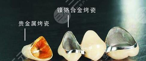 烤瓷牙修復能美白牙齒嗎?
