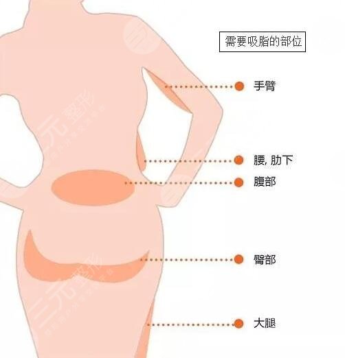 黃金微雕腰腹吸脂手術(shù)注意事項