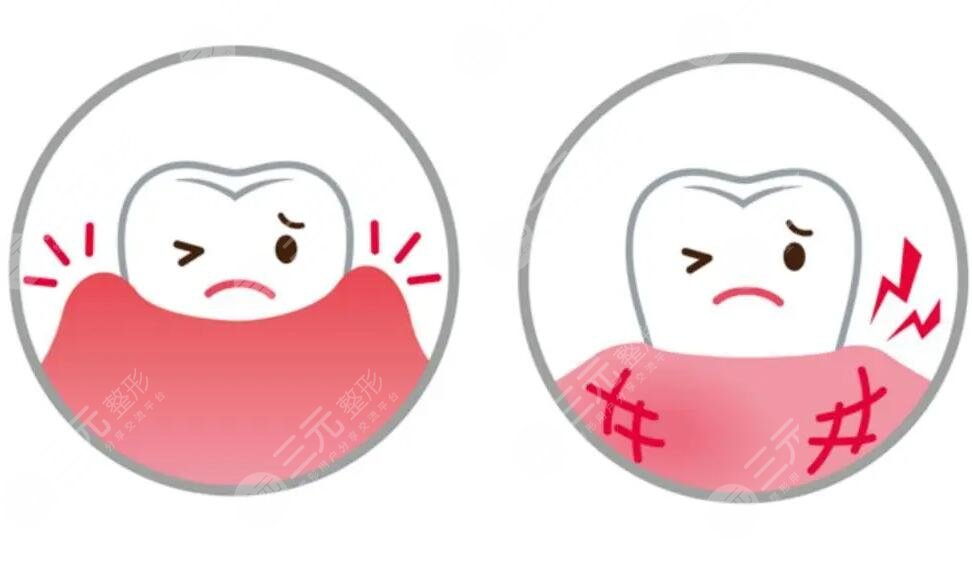 牙齦腫痛如何快速消腫止痛?