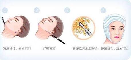 宋延剛醫(yī)生面吸案例分享