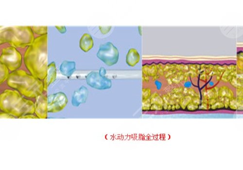 德國(guó)水動(dòng)力吸脂怎么樣？