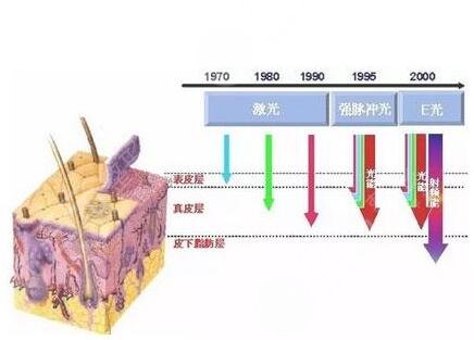 激光緩解臉部紅血絲怎么樣?