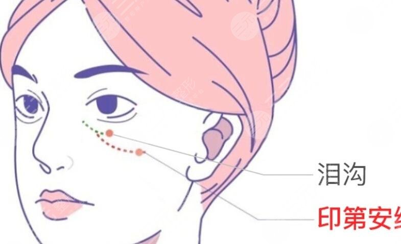 填充淚溝