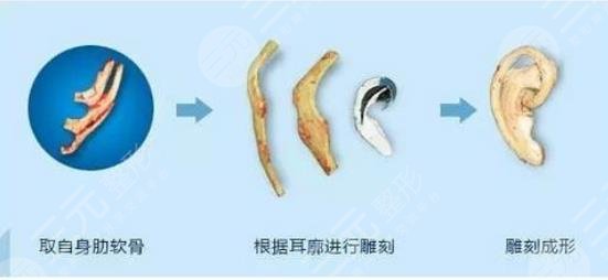 外耳再造手術(shù)需要多少費用？價格表大全，匯總分享！