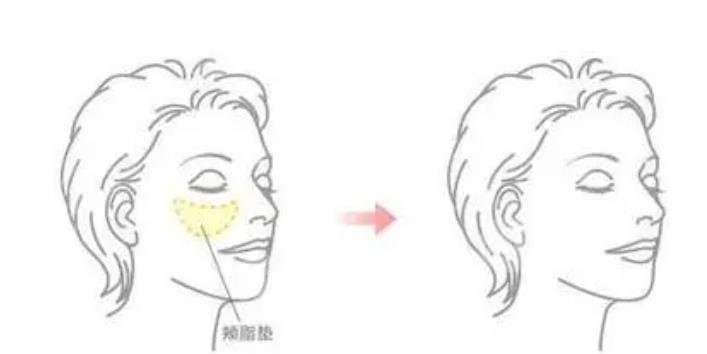 去頰脂墊