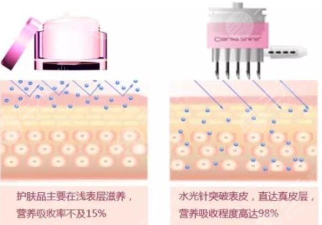 貴婦水光針是什么樣的