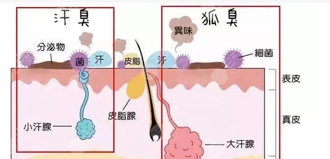 掉狐臭