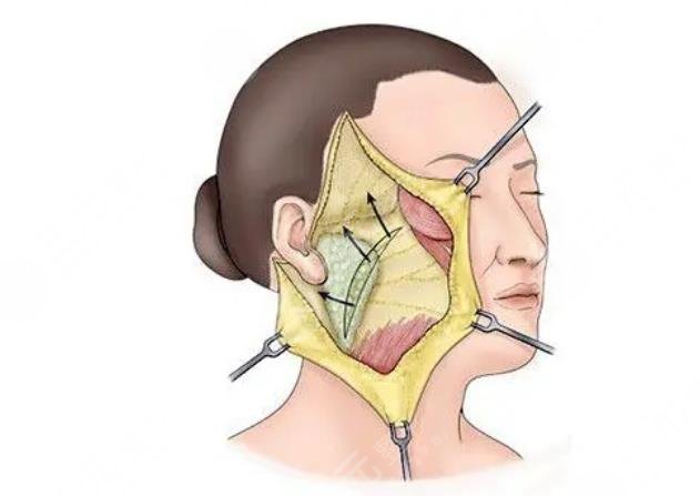 楊萬忠醫(yī)生拉皮手術(shù)案例