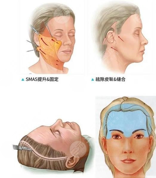 楊萬忠醫(yī)生拉皮手術(shù)案例