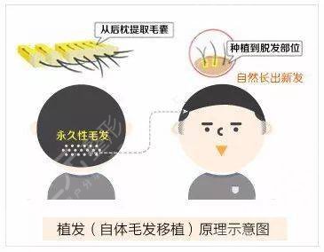 頭發(fā)怎么種?植的?植發(fā)具體操作流程