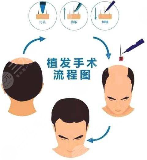 頭發(fā)怎么種?植的?植發(fā)具體操作流程