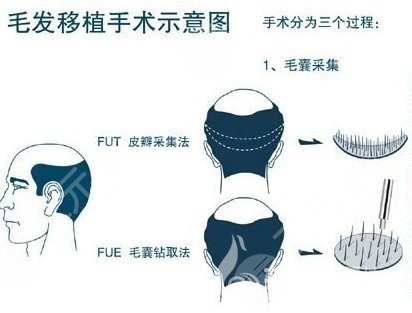 頭發(fā)怎么種?植的?植發(fā)具體操作流程